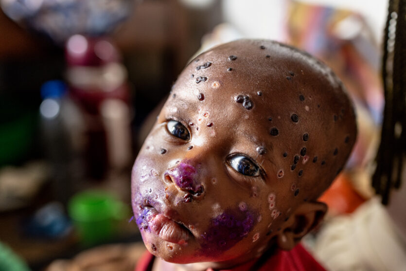 Pascal Maitres Reportage „Mpox“ dokumentiert die Auswirkungen der Viruserkrankung Mpox in der Demokratischen Republik Kongo. Besonders im Fokus steht Japhet, ein sieben Monate alter Junge, dessen Gesicht durch die Krankheit entstellt ist und der in einem spärlich ausgestatteten Krankenhaus behandelt wird. Neben der medizinischen Versorgung des Kindes zeigt Maitre die Herausforderungen in überfüllten Lagern, wo die Krankheit sich weiter ausbreiten kann. Seine Bilder verdeutlichen die prekäre Lage und die unzureichende Gesundheitsversorgung in Krisenregionen. © Pascal Maitre / UNICEF Foto des Jahres 2024